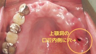 上顎洞炎、歯周病が原因で鼻の部屋に穴があいてしまった